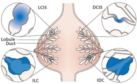 [pdf] Molecular Genetics Of Lobular Breast Cancer Ductal Carcinoma In