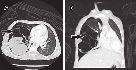 -Computed tomography scan of the multicystic pulmonary hamartoma ...