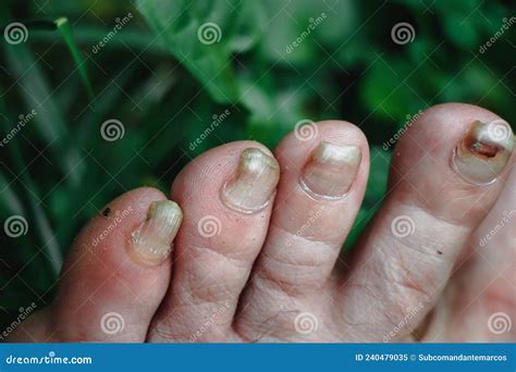 Toenails Affected By An Infectious Disease Fungal Infection Of The Nail