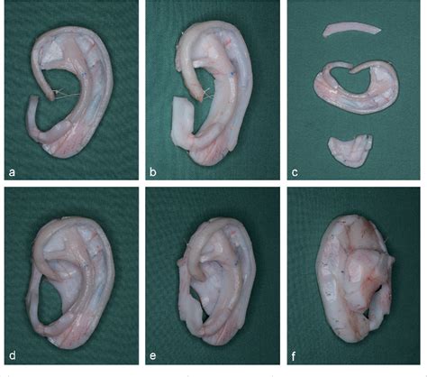 The Rib Cartilage Concept In Microtia Semantic Scholar