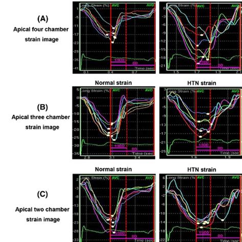 Strain In The Apical 4 3 And 2 Chamber Views In A Hypertensive