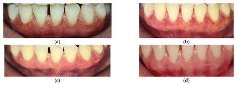 Dentistry Journal Free Full Text Evaluation Of Carbon Dioxide Laser