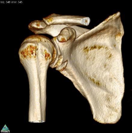 Bankart And Hill Sachs Lesions Image Radiopaedia Org