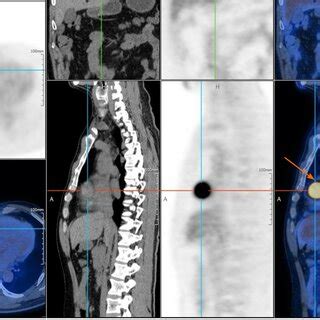 Positron emission tomography/computed tomography. Positron emission... | Download Scientific Diagram