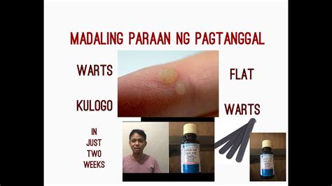 Paano Matanggal Ang Kulugo DIY Warts Removal On Easy Steps YouTube