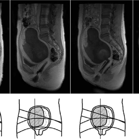 Contrast Enhanced Magnetic Resonance Imaging Showing The Placental