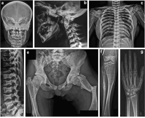 Osteosclerosis Bone