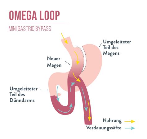 Bariatrische Chirurgie Bariatric Advantage