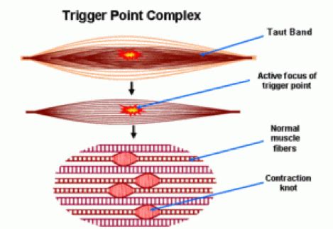 Dry Needling - What is it and how does it work? | Gen Physio