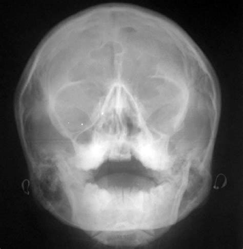 PA Water Showing Hypoplasia Of Zygomatic Bone And Maxillary Sinus