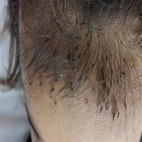 how to take lice out of your hair