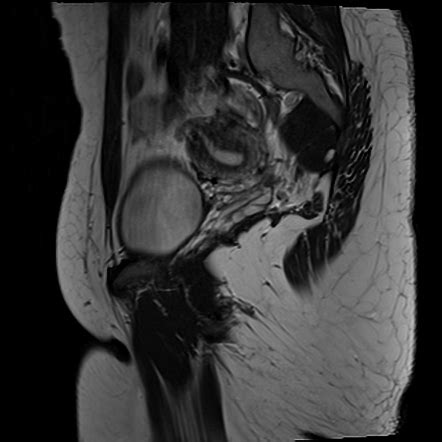 Unicornuate Uterus Image Radiopaedia Org