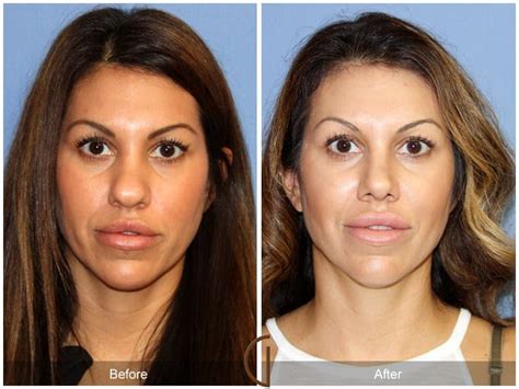 Tip Rhinoplasty Before After Photos From Dr Kevin Sadati