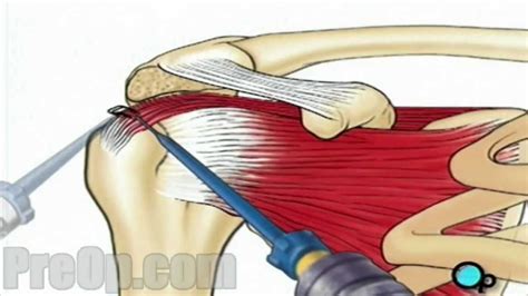 Rotator Cuff Repair Arthroscopic Surgery Preop Patient Education Youtube