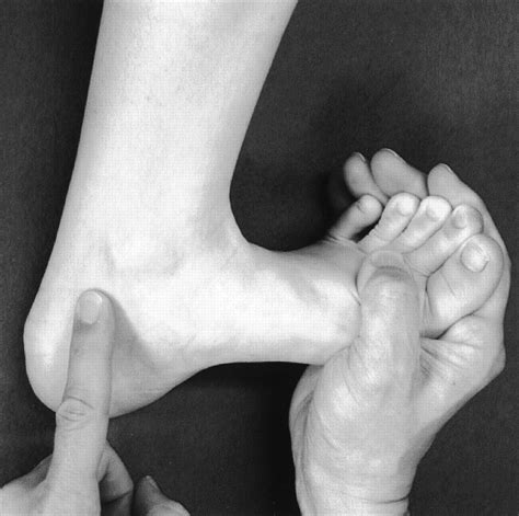 Tarsal Tunnel Syndrome Morphopedics