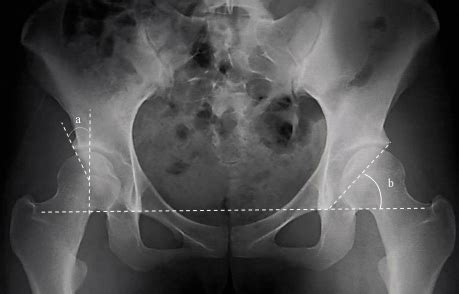 A Radiographic Presentation Of Acetabular Retroversion Is Defined As