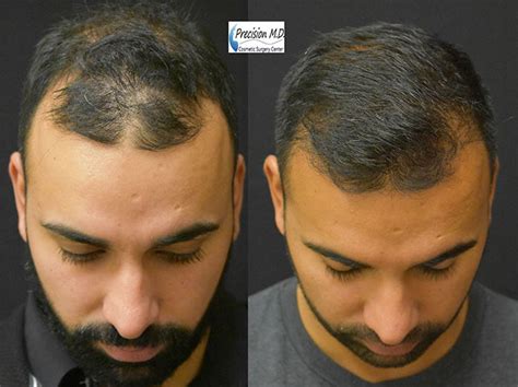 5 Artas Hair Transplant Cost DenieceCree