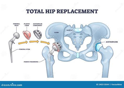 Cirug A De Reemplazo Total De Cadera Con Diagrama De Esquema De