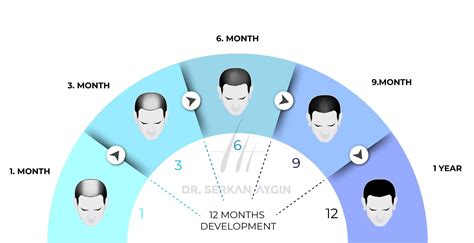 full hair transplant timeline  day   final results