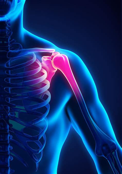 Treating Your Shoulder Pain With Cortisone Injections Dr Matthew