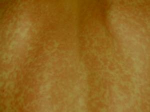 Viral Exanthem Rash - Pictures, Treatment, Symptoms,