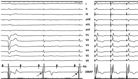 Recording Of Lbb Potential Twelve Lead Ecg And Intracardiac