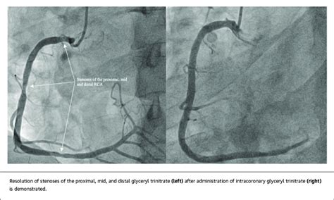 Coronary Angiogram: Patient 3 | Download Scientific Diagram