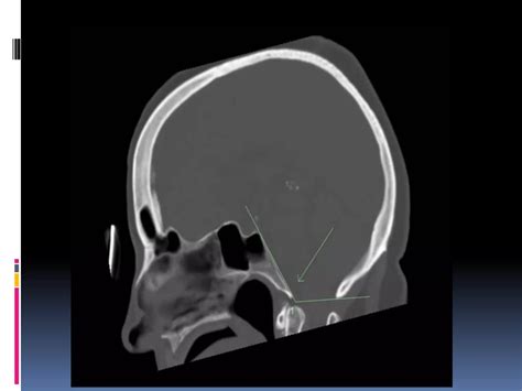 Imaging Of The Craniovertebral Junction Ppt