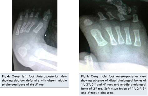 Amniotic Band Syndrome