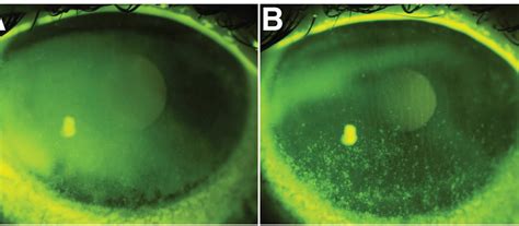 Key Tests For Diagnosing Dry Eye Disease In General Practice New