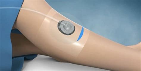 Global Negative Pressure Wound Therapy Market Poised For Robust Growth