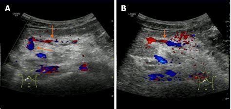 Umbilical Artery Ultrasound