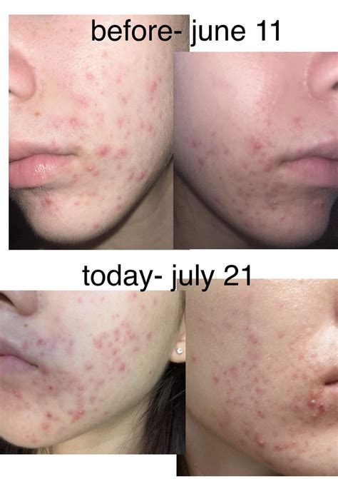 Purging Or Irritation Routine Info In Comments R Tretinoin