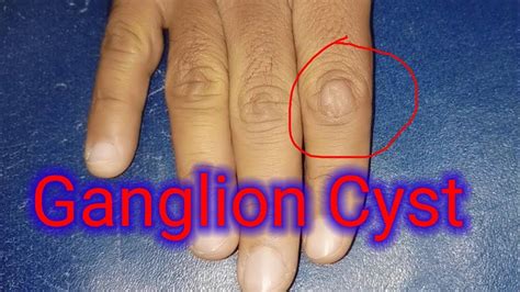 Ganglion Cyst Distal Interphalangeal Joint Finger Youtube