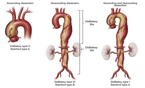 Painless Aortic Dissection Revealed After its Rupture to the ...
