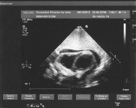 -Echocardiography of the patient, subcostal view. | Download Scientific ...