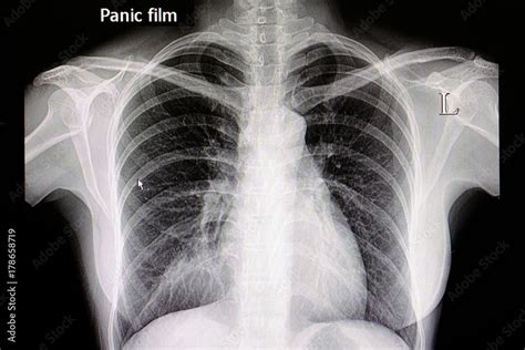 chest x-ray film of patient with pneumonia Stock Photo | Adobe Stock