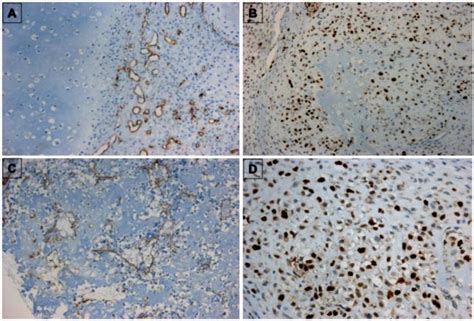 Immunohistochemistry Of Bone Sarcomas A Cd Immunostained