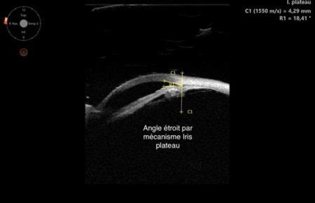 Echographies Oculaires Et Ubm Institut Ophtalmologique Sourdille