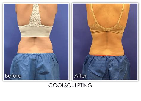 Coolsculpting Pro Archives Skin Rejuvenation Clinic Skin Rejuvenation