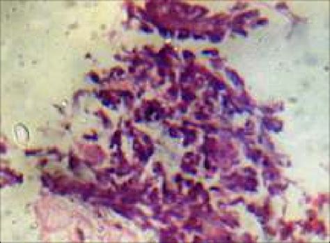 Hpe Of Ct Guided Tru Cut Lung Biopsy Showing Sheets Of Small Round