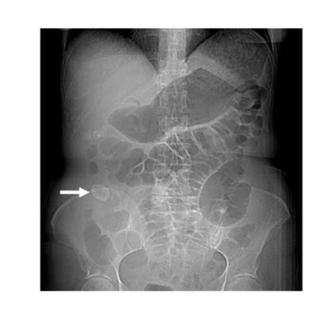 Bowel Obstruction Flashcards Quizlet