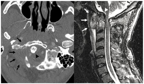 Cervical Spine Anatomy Ct Scan