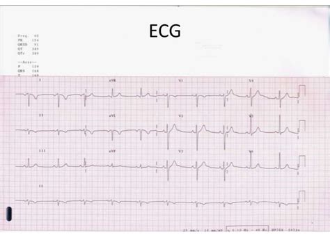 Ecg Reversal Of Limb Leads Ppt