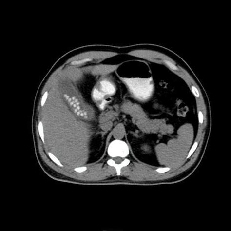 Acute Calculus Cholecystitis Medizzy