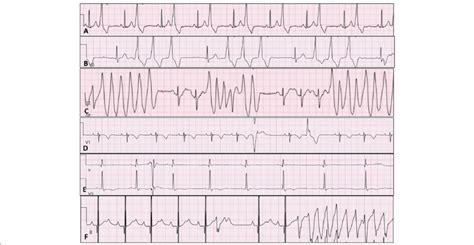 A Premature Ventricular Contractions Pvcs Uniform In Morphology And