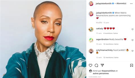 Qu est ce que l alopécie la maladie de Jada Pinkett Smith ENTRE NOUS