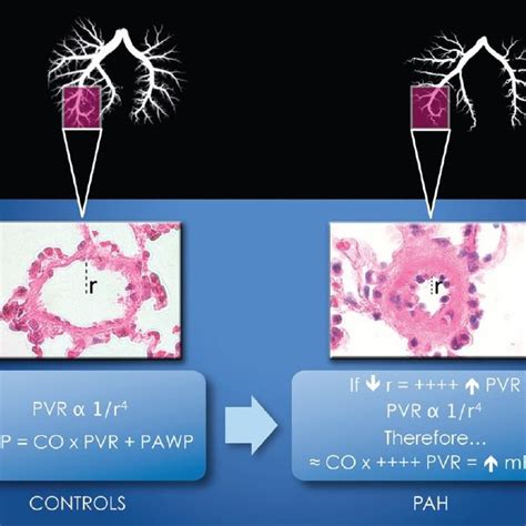 Updated Clinical Classification Of Pulmonary Hypertension Dana Point