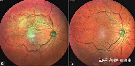 黄斑疾病——4、黄斑前膜 知乎