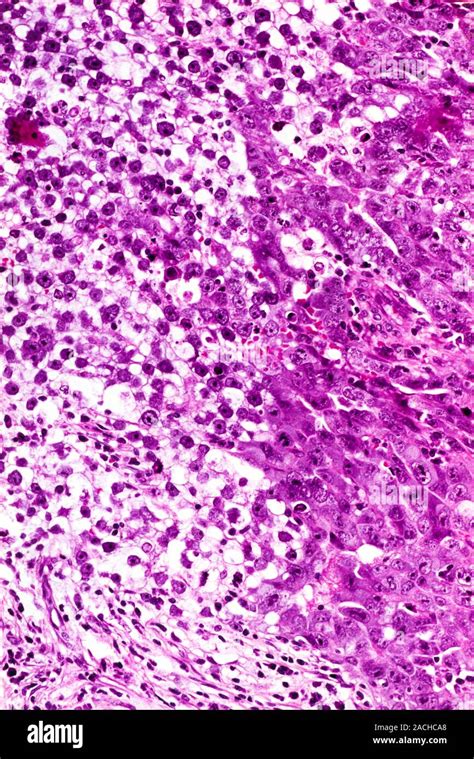 Testicular Cancer Light Micrograph Of A Section Through An